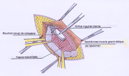 erniainguinale012